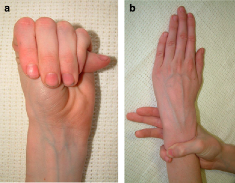 Rhumatologie - Syndromes de Marfan et apparentés