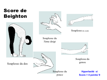 Rhumatologie - Syndromes de Marfan et apparentés