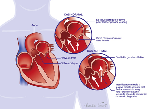 Remplacement valve aortique : Quand faut-il le faire ?